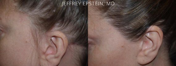 Repair Facelift Scarring Before and after in Miami, FL, Paciente 40279