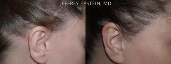 Reparación Cicatriz de Estiramiento Facial Before and after in Miami, FL, Paciente 93454