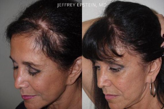 Reparación Cicatriz de Estiramiento Facial Before and after in Miami, FL, Paciente 93443