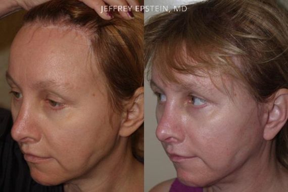 Reparación Cicatriz de Estiramiento Facial Before and after in Miami, FL, Paciente 93422