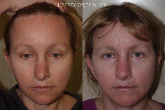 Reparación Cicatriz de Estiramiento Facial Before and after in Miami, FL, Paciente 93422