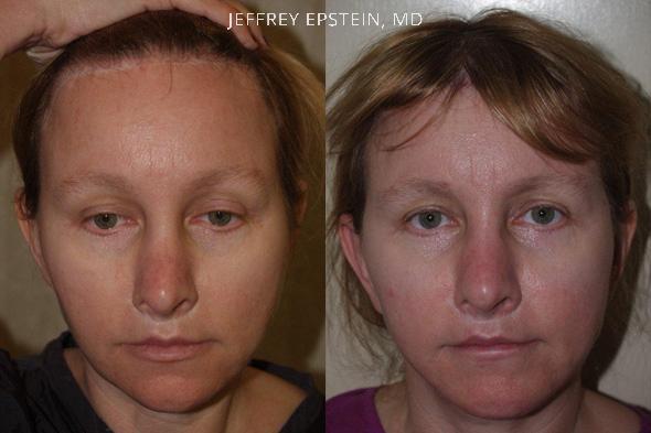 Repair Facelift Scarring Before and after in Miami, FL, Paciente 40287