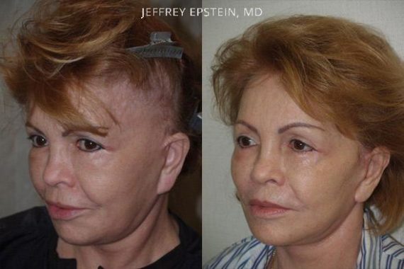Reparación Cicatriz de Estiramiento Facial Before and after in Miami, FL, Paciente 93391