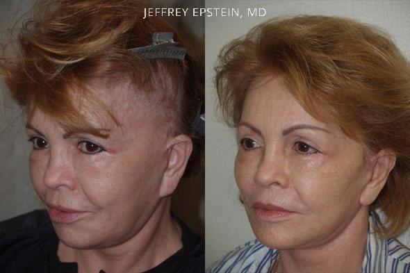 Repair Facelift Scarring Before and after in Miami, FL, Paciente 40292