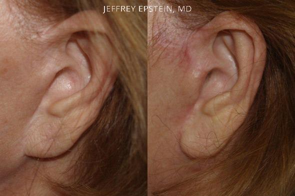 Repair Facelift Scarring Before and after in Miami, FL, Paciente 40292