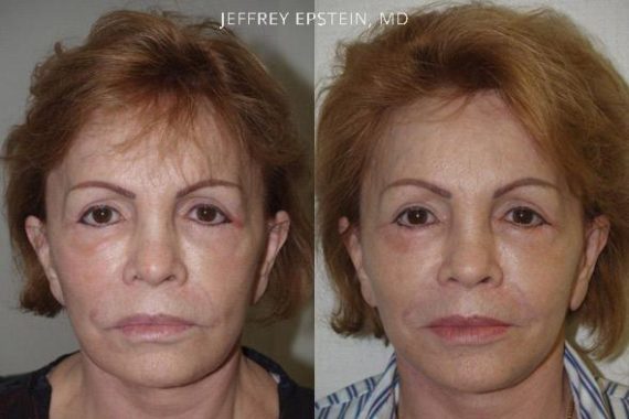 Reparación Cicatriz de Estiramiento Facial Before and after in Miami, FL, Paciente 93391