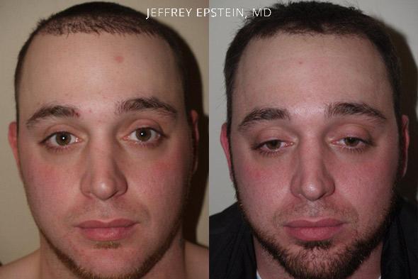 Reparative Hair Transplant Before and after in Miami, FL, Paciente 40299