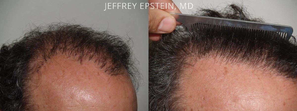 Reparative Hair Transplant Before and after in Miami, FL, Paciente 40306