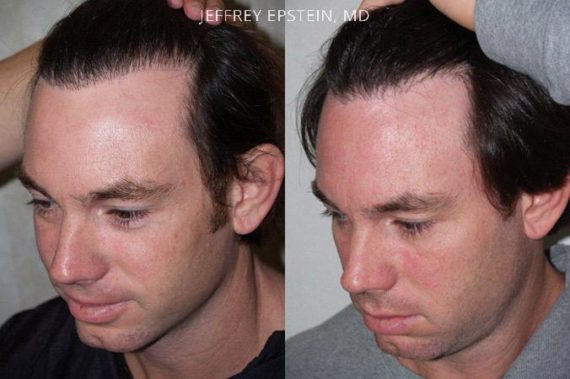 Reparative Hair Transplant Before and after in Miami, FL, Paciente 40313