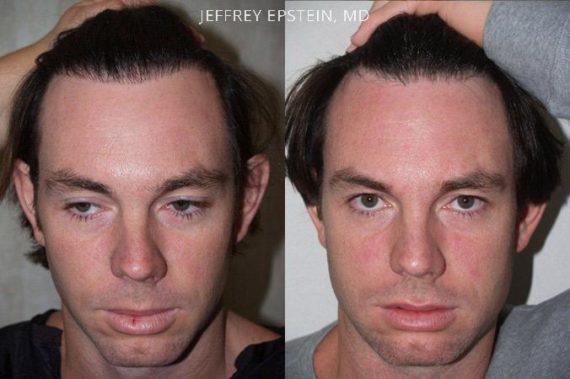 Reparative Hair Transplant Before and after in Miami, FL, Paciente 40313