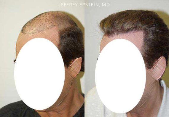 Reparative Hair Transplant Before and after in Miami, FL, Paciente 40328