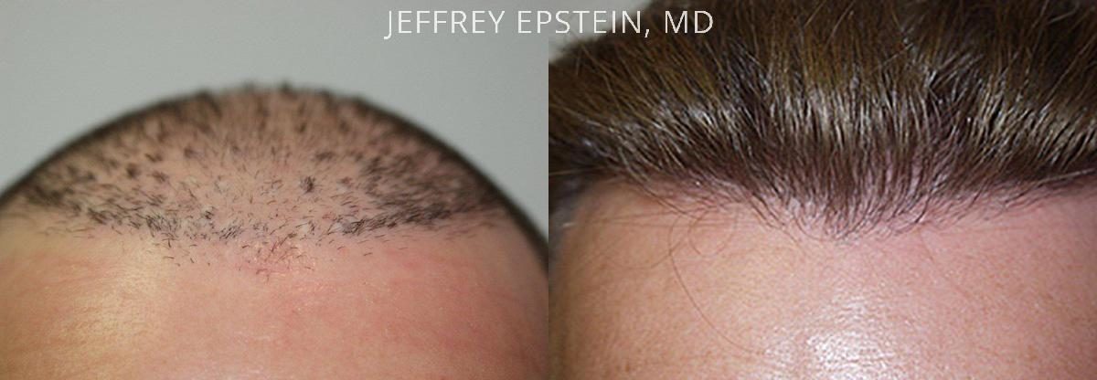 Reparative Hair Transplant Before and after in Miami, FL, Paciente 40328