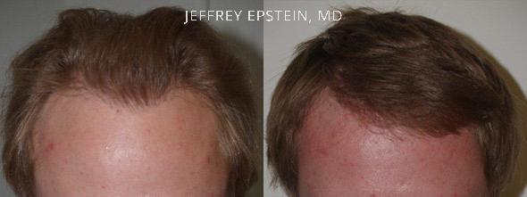 Reparative Hair Transplant Before and after in Miami, FL, Paciente 40333