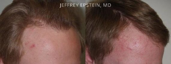 Reparative Hair Transplant Before and after in Miami, FL, Paciente 40333
