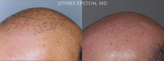 Reparative Hair Transplant Before and after in Miami, FL, Paciente 40341