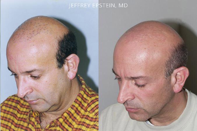 Reparative Hair Transplant Before and after in Miami, FL, Paciente 40341
