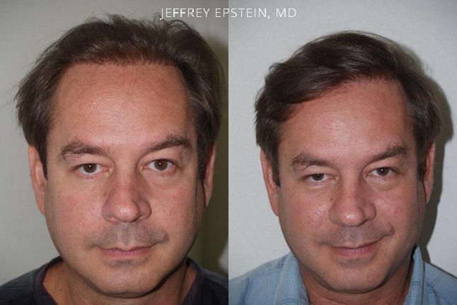 Reparative Hair Transplant Before and after in Miami, FL, Paciente 40346