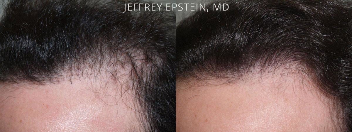 Reparative Before and after in Miami, FL, Paciente 40353