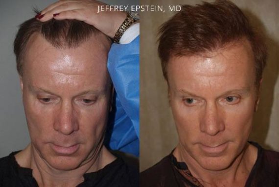 Reparative Hair Transplant Before and after in Miami, FL, Paciente 40358