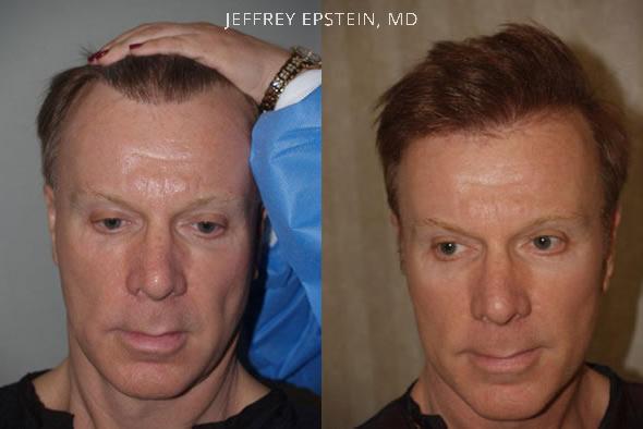 Reparative Hair Transplant Before and after in Miami, FL, Paciente 40358
