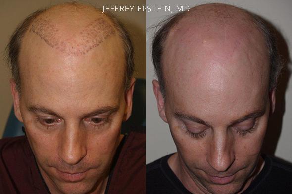 Reparative Hair Transplant Before and after in Miami, FL, Paciente 40367
