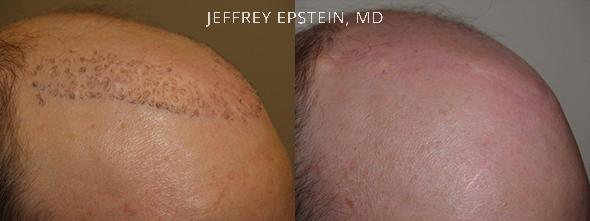 Reparative Hair Transplant Before and after in Miami, FL, Paciente 40367