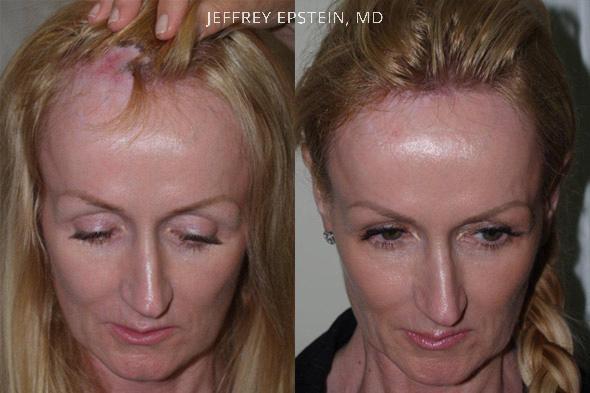 Reparative Hair Transplant Before and after in Miami, FL, Paciente 40380