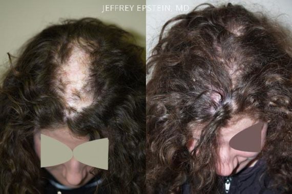 Reparative Hair Transplant Before and after in Miami, FL, Paciente 40388