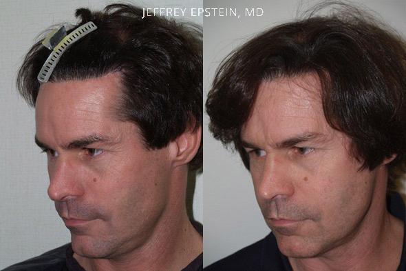 Reparative Hair Transplant Before and after in Miami, FL, Paciente 40391