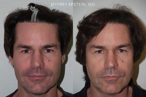 Reparative Hair Transplant Before and after in Miami, FL, Paciente 40391