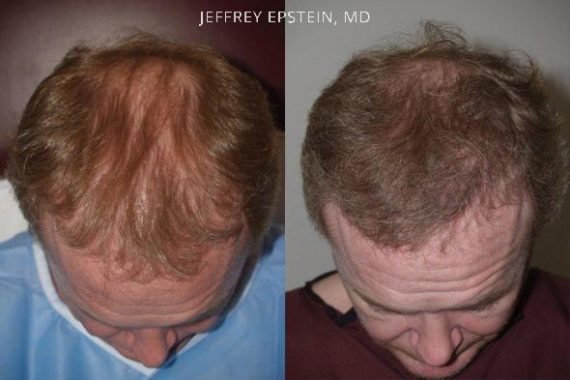 Reparative Hair Transplant Before and after in Miami, FL, Paciente 40400