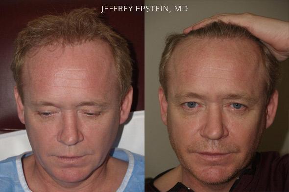 Reparative Hair Transplant Before and after in Miami, FL, Paciente 40400