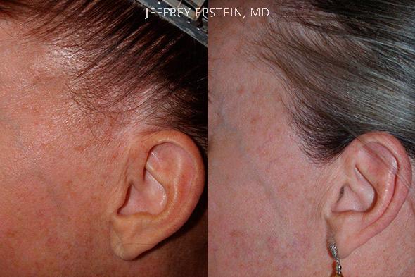 Reparative Hair Transplant Before and after in Miami, FL, Paciente 40412
