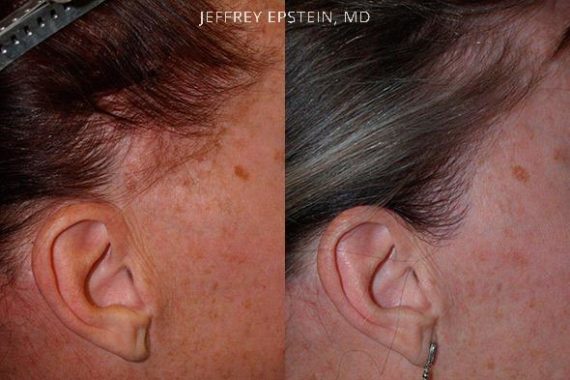 Reparative Hair Transplant Before and after in Miami, FL, Paciente 40412
