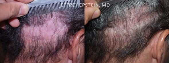 Reparative Hair Transplant Before and after in Miami, FL, Paciente 40417