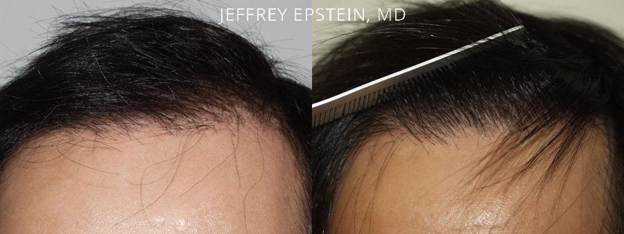 Reparative Hair Transplant Before and after in Miami, FL, Paciente 40420