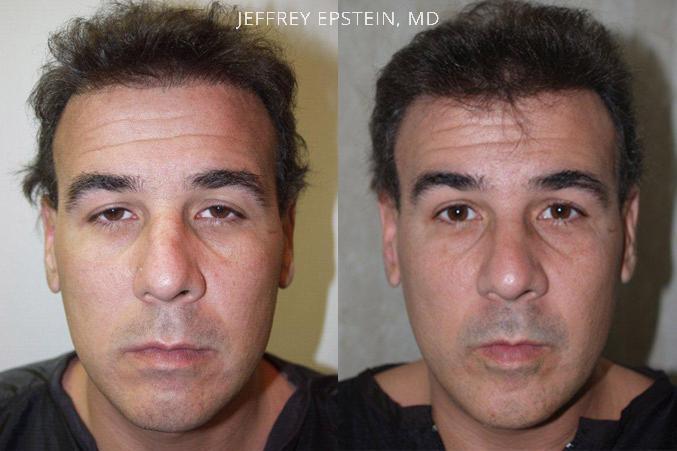 Reparative Hair Transplant Before and after in Miami, FL, Paciente 40425
