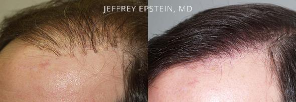 Reparative Hair Transplant Before and after in Miami, FL, Paciente 40430