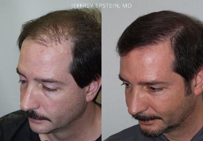 Reparative Hair Transplant Before and after in Miami, FL, Paciente 40430