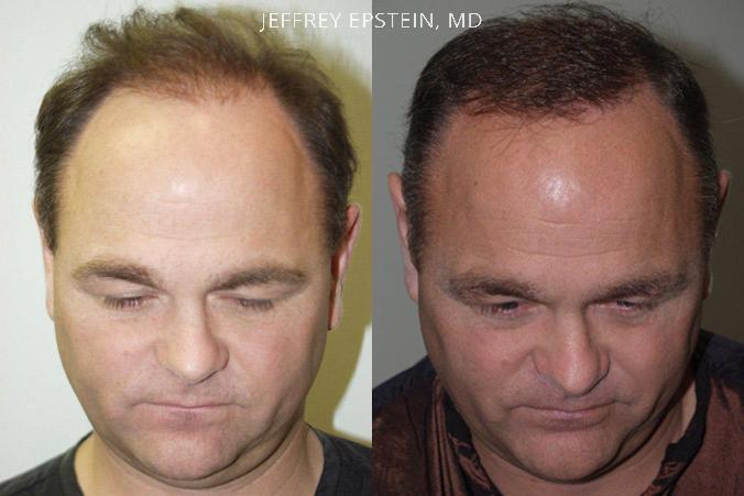 Reparative Hair Transplant Before and after in Miami, FL, Paciente 40435