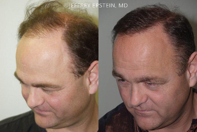 Reparative Hair Transplant Before and after in Miami, FL, Paciente 40435