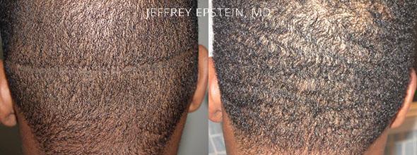 Reparative Hair Transplant Before and after in Miami, FL, Paciente 40444