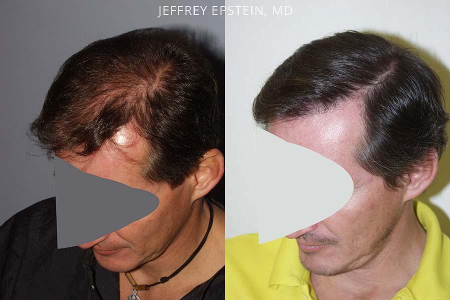 Reparative Hair Transplant Before and after in Miami, FL, Paciente 40447