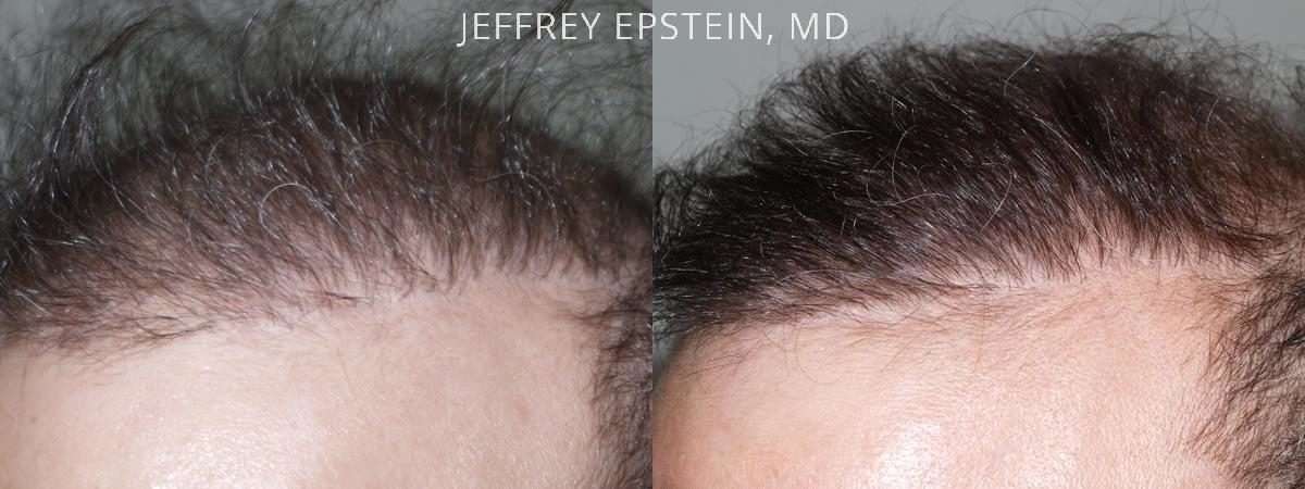 Reparative Hair Transplant Before and after in Miami, FL, Paciente 40457