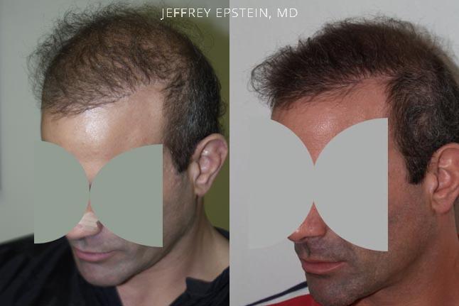 Reparative Hair Transplant Before and after in Miami, FL, Paciente 40457