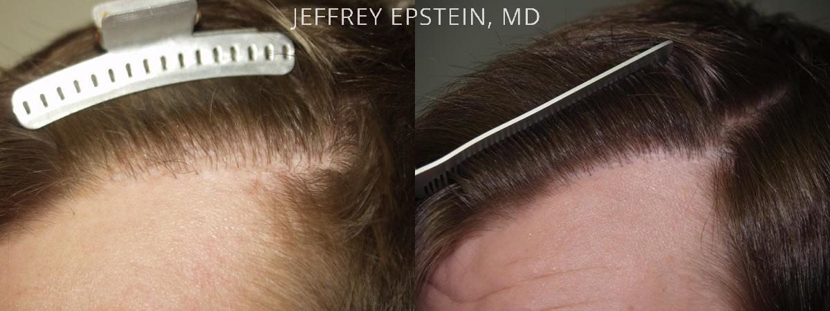 Reparative Hair Transplant Before and after in Miami, FL, Paciente 40462