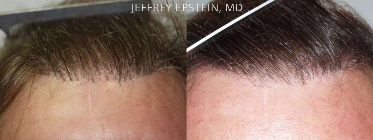 Reparative Hair Transplant Before and after in Miami, FL, Paciente 40469