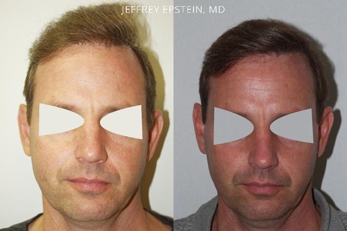 Reparative Hair Transplant Before and after in Miami, FL, Paciente 40469