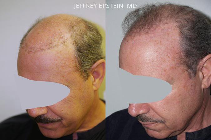Reparative Hair Transplant Before and after in Miami, FL, Paciente 40474