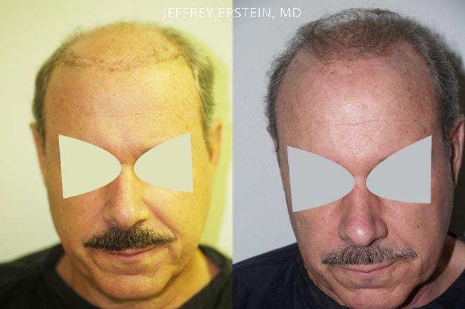 Reparative Hair Transplant Before and after in Miami, FL, Paciente 40474
